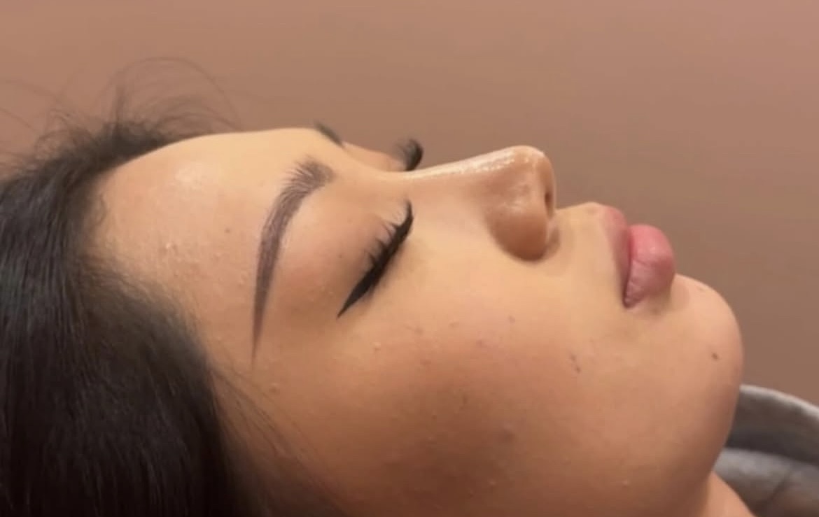 Chin filler before treatment
